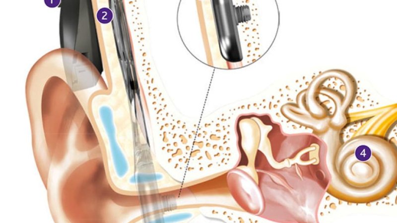 Ilustração do implante auditivo ancorado ao osso (OSIA) na anatomia do ouvido