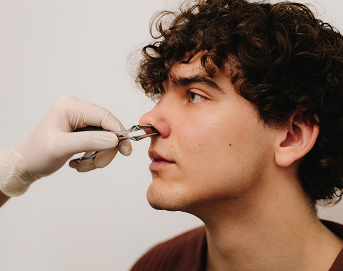 Desvio de septo nasal
